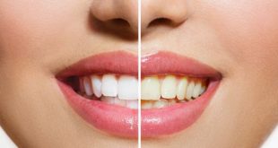 تغذیه و دندان هایی سفید- دستور العمل های تغذیه برای سفیدی دندان!!