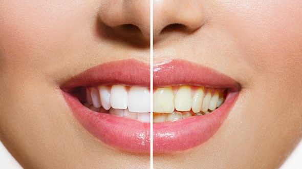 تغذیه و دندان هایی سفید- دستور العمل های تغذیه برای سفیدی دندان!!