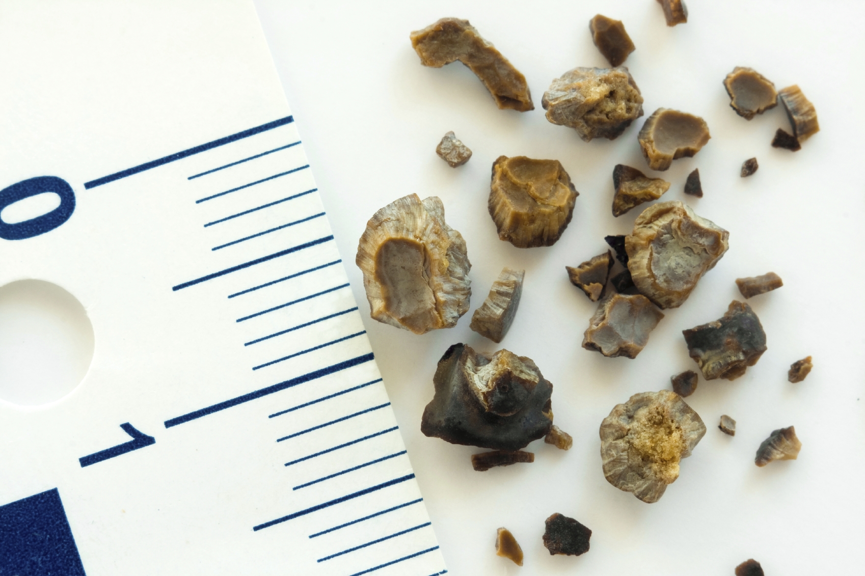 image of kidney stone in body image of kidney stone in body