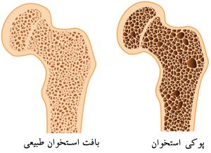 تقویت استخوان ها با سه ویتامین ضروری